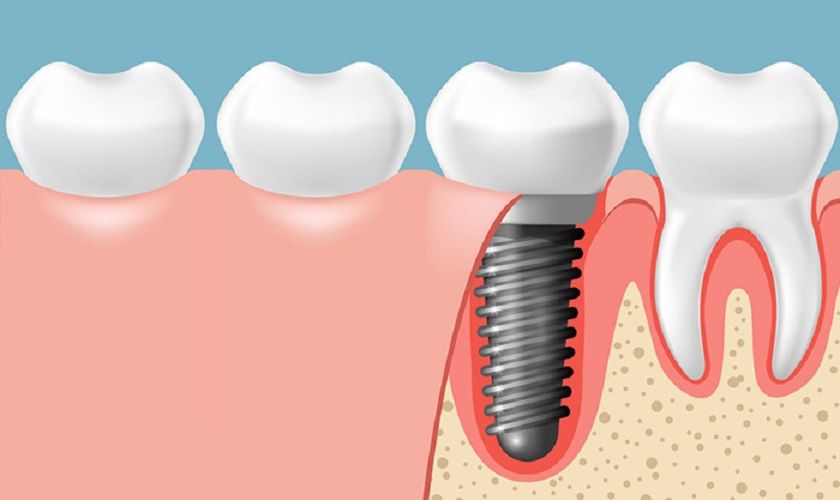 Trồng răng implant là phương pháp phục hình răng đã mất hiện đại và bền vững nhất.